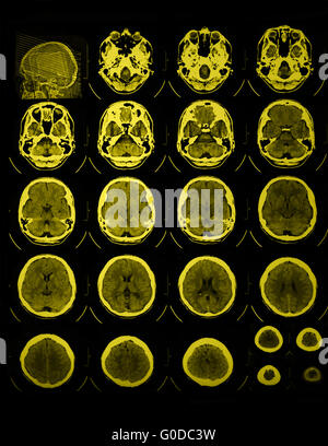 Foto di CT e MRI del cranio Foto Stock