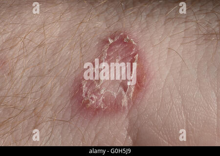Tigna sull'uomo bianco / micosi Foto Stock