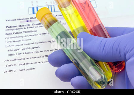 Campione di sangue e la richiesta di laboratorio per anti-HIV Test Foto Stock
