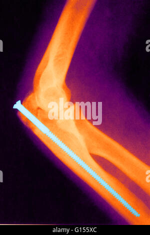 Colore esaltato raggi X di un braccio rotto con un perno metallico introdotto nella cavità del midollo al fine di rafforzare l'osso. Il filo può anche essere avvolto attorno all'osso per assistere a dritte e piastre di metallo può anche facilitare la guarigione corretta nel caso di un Foto Stock