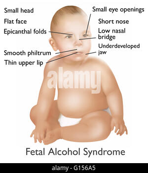Illustrazione del bambino con la sindrome alcolica fetale. La sindrome alcolica fetale o (FAS) è una condizione in lattanti che è causata dal consumo di alcool da parte della madre durante la gravidanza. Fisica e Mentale dei difetti come una piccola testa, faccia piana, epicanth Foto Stock