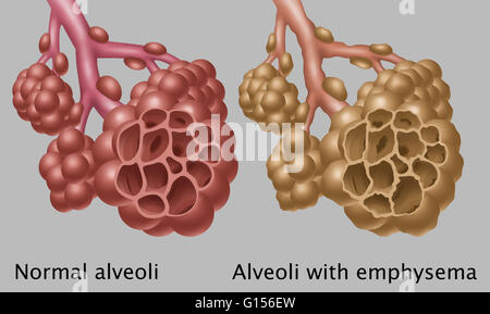 Illustrazione confrontando la comparsa di normale alveoli (sinistra) con alveoli con enfisema (a destra). Enfisema è più spesso causato dal fumo di tabacco. Foto Stock