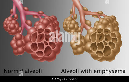 Illustrazione confrontando la comparsa di normale alveoli (sinistra) con alveoli con enfisema (a destra). Enfisema è più spesso causato dal fumo di tabacco. Foto Stock