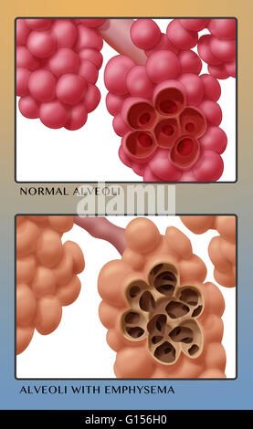 Illustrazione confrontando l'aspetto di una sana alveoli (top) e gli alveoli con enfisema (fondo). Gli alveoli sono situati nei polmoni. Essi sono di piccole sacche d'aria alla fine dell'albero respiratorio. Enfisema, una malattia in cui gli alveoli vengono danneggiati, è Foto Stock