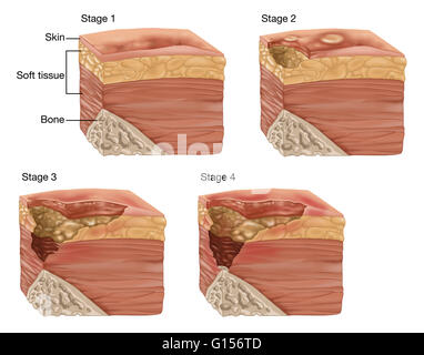 Illustrazione che mostra le 4 fasi di un bedsore o mal di pressione. Piaghe da decubito può essere causata da molti fattori tra cui la pressione non alleviata, attrito, umidità, ecc. Piaghe da decubito solitamente affliggono i deboli e gli anziani, sedia a rotelle legato persone e malati terminali. Foto Stock