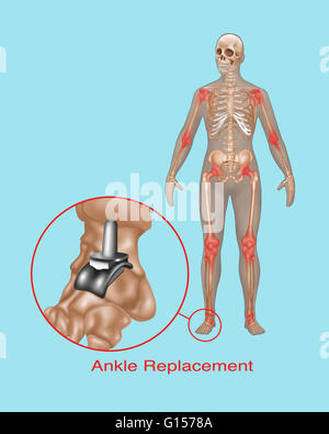 Illustrazione di una articolazione della caviglia la sostituzione. Foto Stock