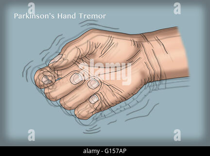 Illustrazione di una mano tremore, uno dei sintomi della malattia di Parkinson. Foto Stock