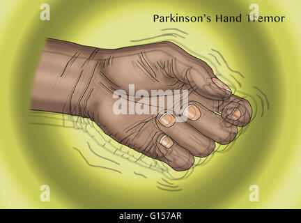 Illustrazione di una mano tremore, uno dei sintomi della malattia di Parkinson. Foto Stock