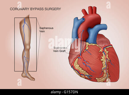 La chirurgia dei bypass coronarici, denominata illustrazione. Una nave dal paziente la vena grande safena (in gamba) è innestato tra l'aorta e la coronaria ostruito, a valle dell'ostruzione, in modo da ripristinare il sangue di irrigazione del cuore. Foto Stock