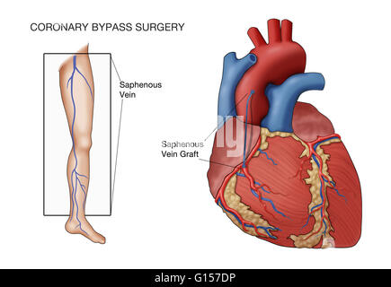 La chirurgia dei bypass coronarici, denominata illustrazione. Una nave dal paziente la vena grande safena (in gamba) è innestato tra l'aorta e la coronaria ostruito, a valle dell'ostruzione, in modo da ripristinare il sangue di irrigazione del cuore. Foto Stock