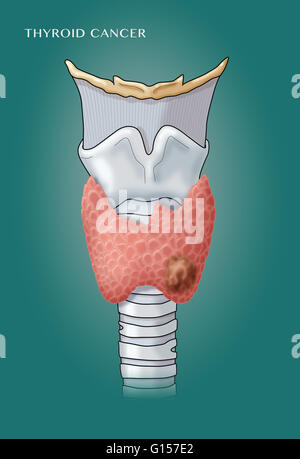 Etichettato illustrazione della laringe e la ghiandola tiroidea, mostrando una crescita maligna (cancro alla tiroide). Foto Stock