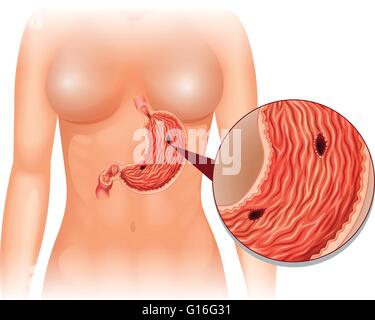 Ulcera di stomaco diagramma nella donna illustrazione Illustrazione Vettoriale
