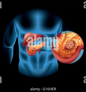 Il cancro del pancreas schema nel corpo umano illustrazione Illustrazione Vettoriale