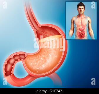 L'acidità nello stomaco umano, illustrazione. Foto Stock