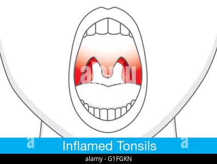 tonsille infette rimosse