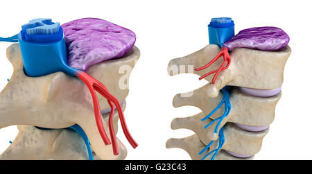 Il midollo spinale sotto pressione di rigonfiamento disc Foto Stock
