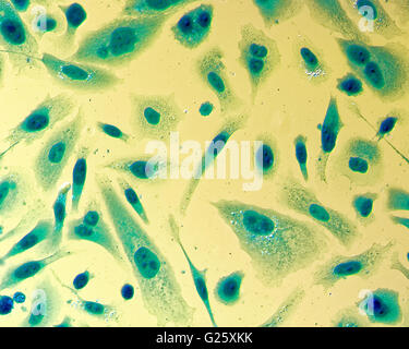 Umana PC-3 di cellule di cancro della prostata, colorati con blu Coomassie, sotto differencial interference contrast microscopio. Foto Stock