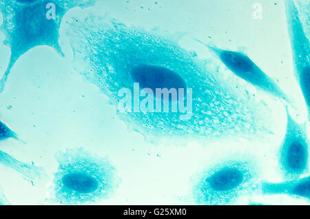 Umana PC-3 di cellule di cancro della prostata, colorati con blu Coomassie, sotto differencial interference contrast microscopio. Foto Stock