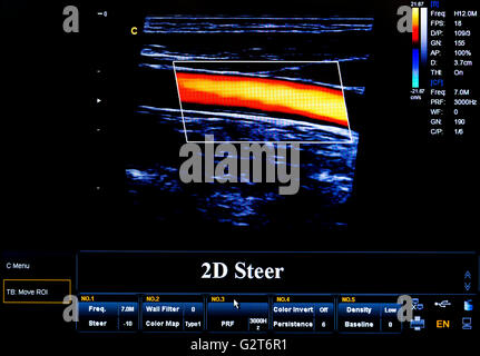 Ecocardiografia moderna (ultrasuoni) monitor della macchina. Immagine a colori. Nuove attrezzature hospitl. 2D Steer. Foto Stock