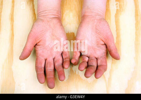 Artrite reumatoide le mani. Sfondo di legno Foto Stock