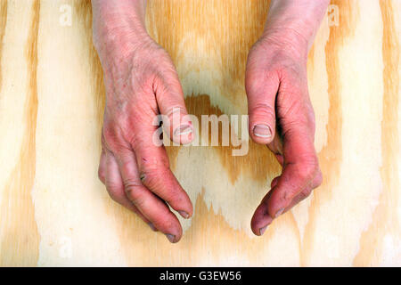 Artrite reumatoide le mani. Sfondo di legno Foto Stock