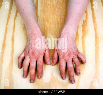 Artrite reumatoide le mani. Sfondo di legno Foto Stock