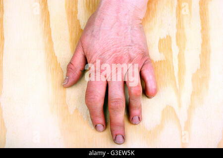 Artrite reumatoide le mani. Sfondo di legno Foto Stock