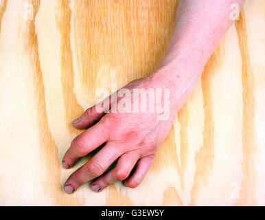 Artrite reumatoide le mani. Sfondo di legno Foto Stock