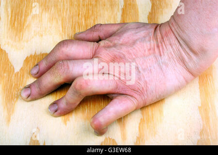 Artrite reumatoide le mani. Sfondo di legno Foto Stock