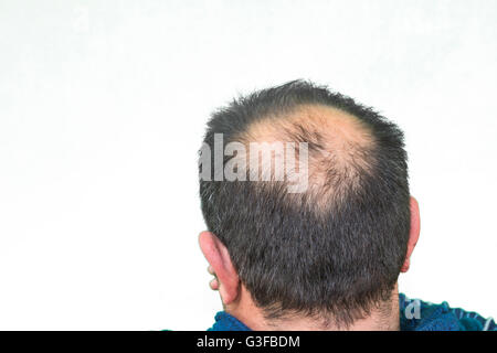Maturo uomo yang, visto da dietro, nella testa, comincia a perdere i capelli, comincia ad essere vecchio. Foto Stock