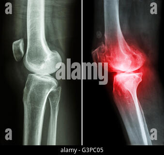 Ginocchio normale ( immagine a sinistra ) e osteoartrite del ginocchio destro ( immagine ) ( vista laterale ) Foto Stock