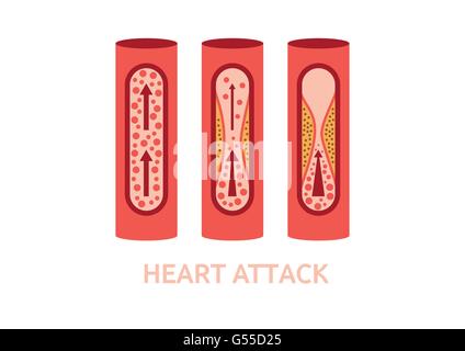 Attacco di cuore i sintomi delle arterie coronarie malattia sanità medicina illustrazione vettoriale Illustrazione Vettoriale