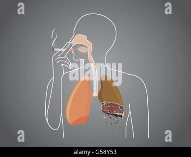 Human bruciate polmone con fumatori Illustrazione Vettoriale