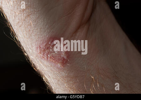 Tigna sull'uomo bianco pelle / fungo infezione / micosi Foto Stock