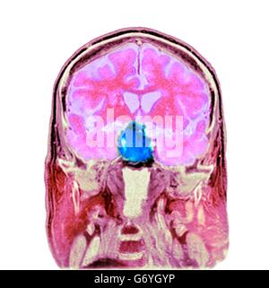 Tumore pituitario. Colorato la tomografia computerizzata (CT) scansione di una sezione attraverso il cervello di un 84-anno-vecchio paziente di sesso maschile con un tumore (rotondo, centro) che colpiscono la ghiandola pituitaria. La ghiandola pituitaria tumori sono solitamente adenomi - benigno (non cancerosi) ari Foto Stock