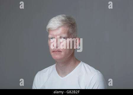 Ritratto di albino uomo contro uno sfondo grigio Foto Stock