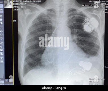 Paziente ha cuore pionieristico impianto di pompa Foto Stock