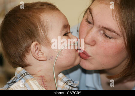 Cuore Artificiale boy lascia ospedale dopo 120 giorni Foto Stock