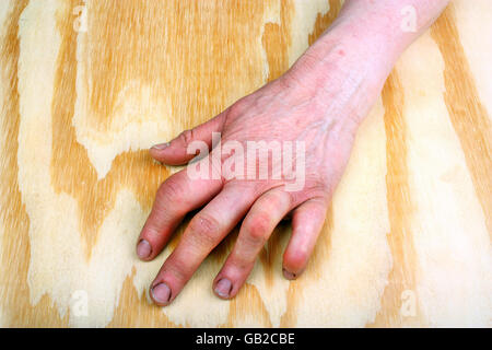 Artrite reumatoide mano su un tavolo di legno Foto Stock