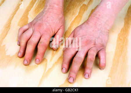 Artrite reumatoide mano su un tavolo di legno Foto Stock