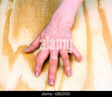 Artrite reumatoide mano su un tavolo di legno Foto Stock