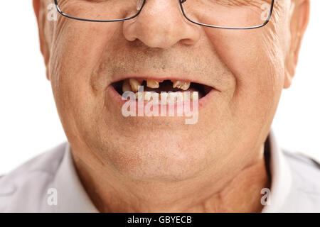 Close-up studio shot sulla bocca di un uomo anziano con un paio di denti rotti isolati su sfondo bianco Foto Stock