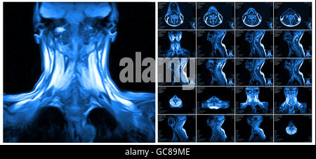 Il rilevamento di immagini in risonanza magnetica nucleare della colonna vertebrale cervicale. Foto Stock