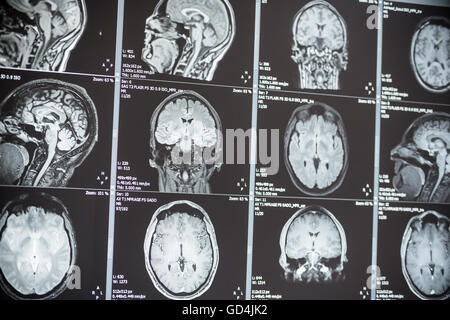 Immagini a risonanza magnetica (MRI) di un cervello Foto Stock