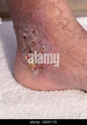Immagini mediche: infezione cellulite sulla pelle di una caviglia causato da flebite e coaguli di sangue nella vena. Foto Stock