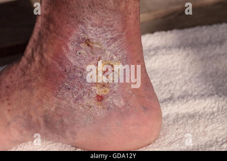 Immagini mediche: infezione cellulite sulla pelle di una caviglia causato da flebite e coaguli di sangue nella vena. Foto Stock