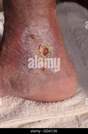 Immagini mediche: infezione cellulite sulla pelle di una caviglia causato da flebite e coaguli di sangue nella vena. Foto Stock