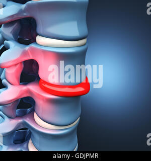 Immagine 3d di ernia del disco vertebrale umana Foto Stock