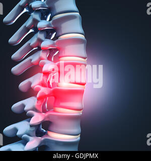 Immagine 3d di ernia del disco vertebrale umana Foto Stock