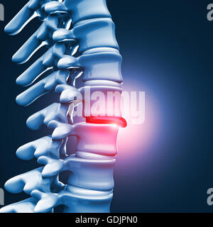 Immagine 3d di ernia del disco vertebrale umana Foto Stock